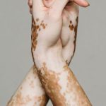 Self-compassion, Acceptance - Hands of person with vitiligo against gray background