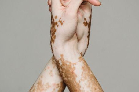 Self-compassion, Acceptance - Hands of person with vitiligo against gray background