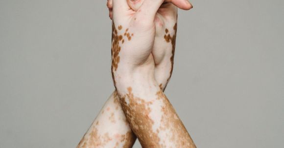 Self-compassion, Acceptance - Hands of person with vitiligo against gray background